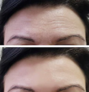 Botox - före och efter